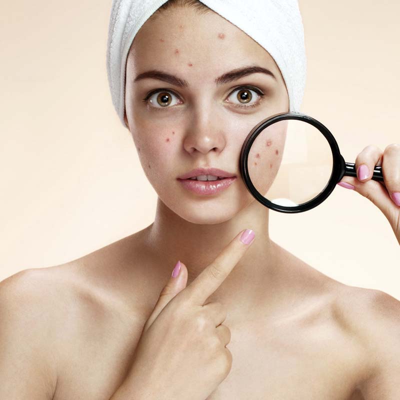 Acne viso e corpo: cause e rimedi