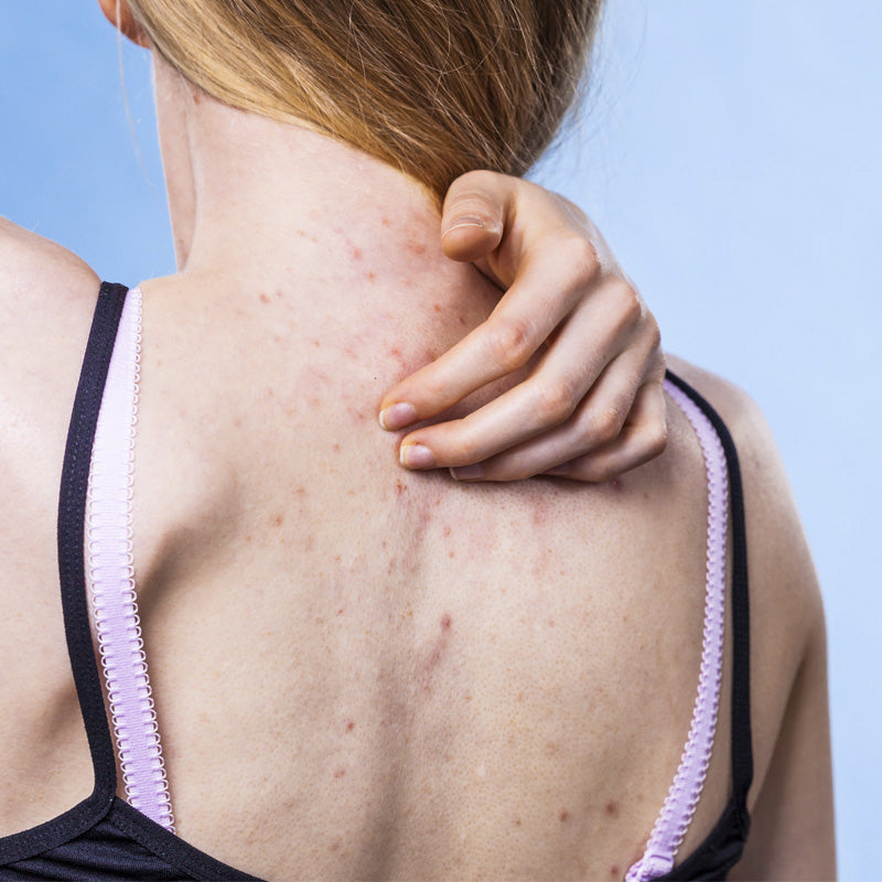 Come eliminare l’acne sulla schiena