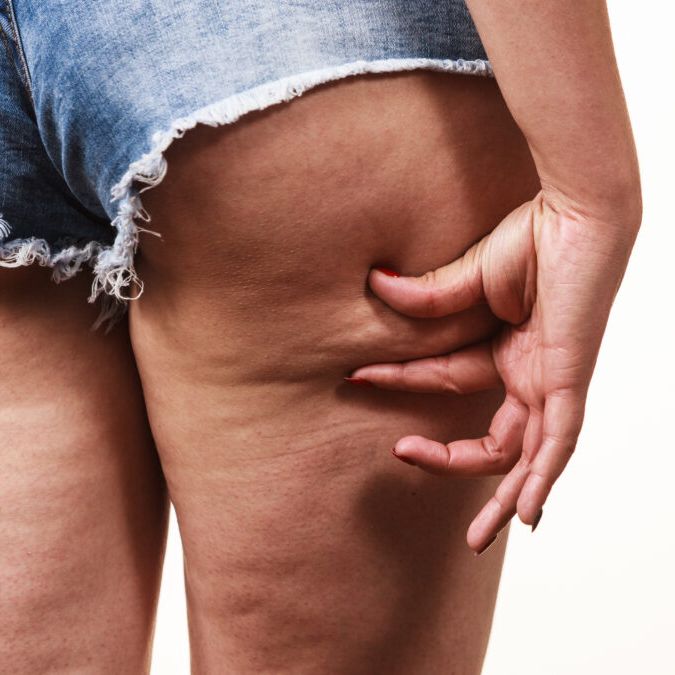 Come eliminare la cellulite: creme, dieta e attività fisica
