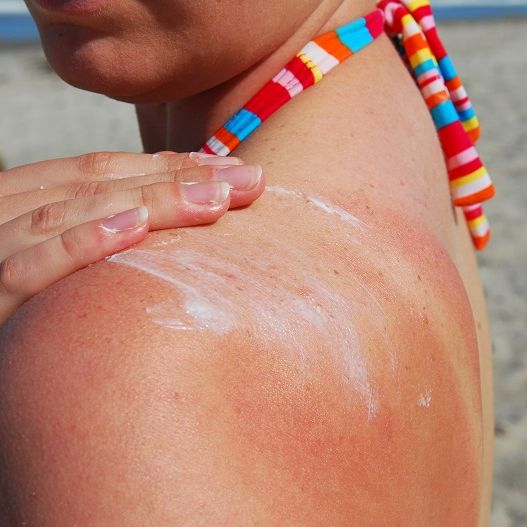 Come evitare le scottature solari
