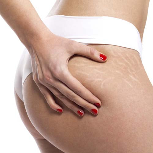 Come fermare le smagliature: trattamento e prevenzione
