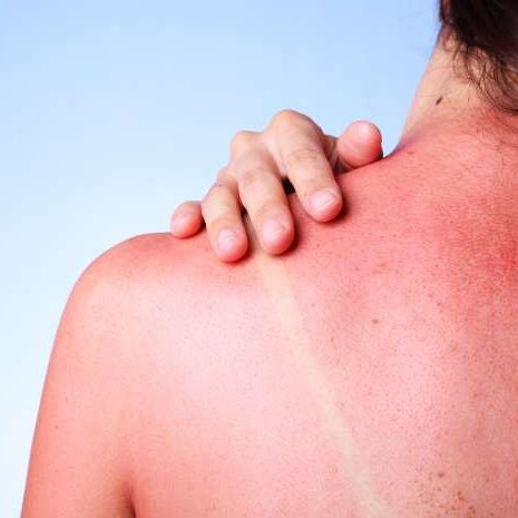 Eritema solare: cos’è e come si cura