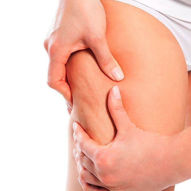 Cellulite: le migliori abitudini per prevenirla