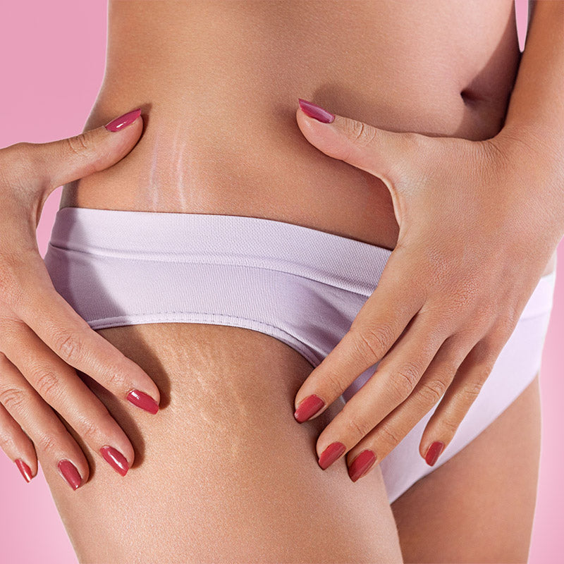 Smagliature: cosa sono e come prevenirle